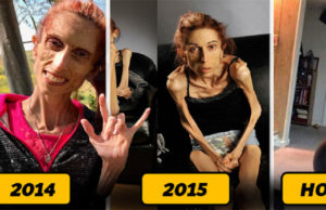 ¿Recuerdas el peor caso de anorexia del mundo? Dio un gran cambio y así luce en la actualidad (+Fotos)