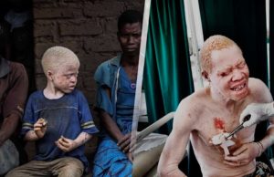 Mira el infierno que viven los albinos en África. Son el platillo más caro del mundo…