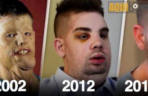 Todos se burlaban de él, pero en el 2012 fue operado y 5 años después nadie lo reconoce
