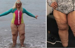 Acosadores se burlan de sus piernas ”asquerosas”; ella publica foto de cerca y les calla la boca