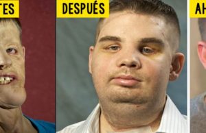 Hunter: El chico que recibió el transplante de cara más caro de la historia muestra su rostro 5 años después