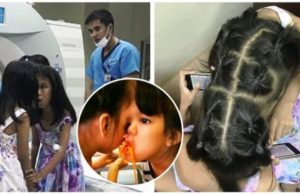Estas siamesas se preparan para la cirugía de separación, de la que solo una saldría son vida