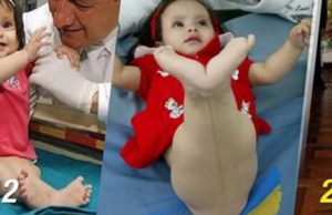 Cómo luce la niña sirena en la actualidad después de 10 años de su operación