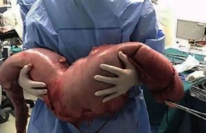 No es un alien, es el caso más extremo de estreñimiento que ha documentado la medicina: la sorprendente enfermedad de Hirschsprung
