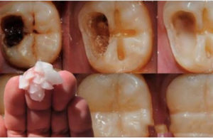 Guárdalo antes de que lo borren, este es el remedio que ningún dentista quiere que descubras, te quita las caries sin dolor