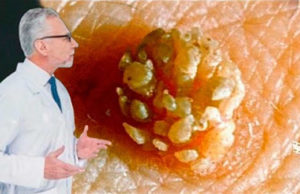 Papiloma humano, estos son los síntomas silenciosos del tipo de papiloma que ocasiona cáncer