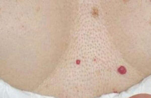Tengo unos puntos rojos en el cuerpo ¿debería preocuparme?