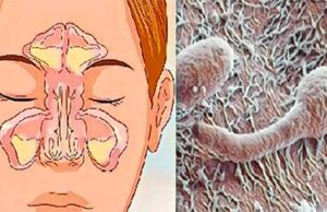 Remedios para la sinusitis y la rinitis
