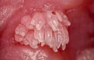 Científicos mexicanos eliminan el Virus de Papiloma Humano en 29 pacientes