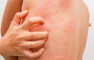 La urticaria es una reacción cutánea y tratamiento